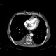 Hepatocellular carcinoma, thrombosis of VCI and right atrium, lung embolism: CT - Computed tomography